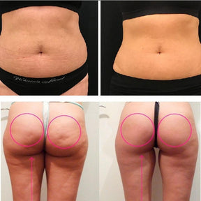 LipoPower - Lipo Without Cuts 